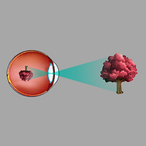 Miopía alteraciones visuales oftalmologia