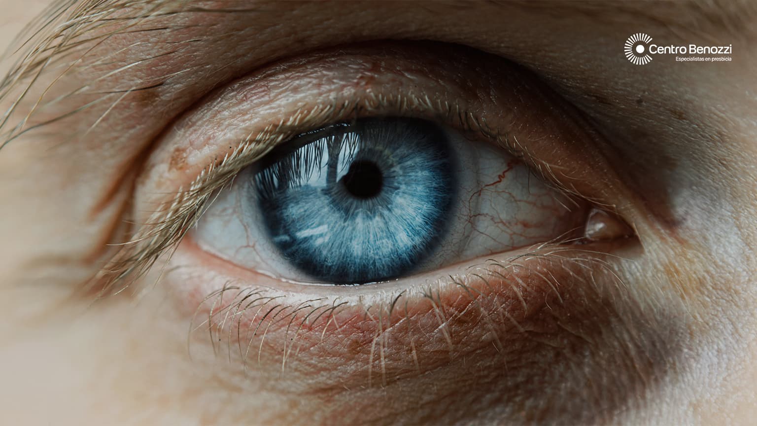 Lentes intraoculares y alternativas quirúrgicas para la presbicia